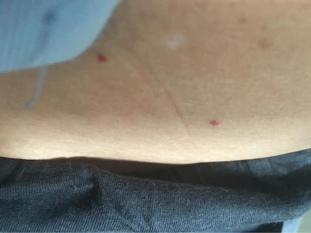 手上长了两颗红痣是什么情况？