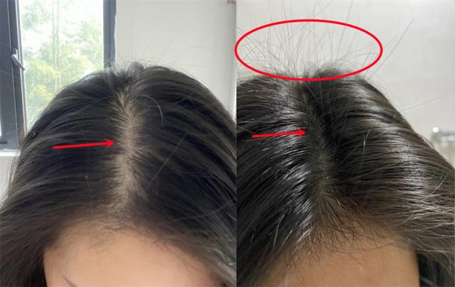生发液真能长头发吗，市面上的生发液是否真的能生发？为什么？
