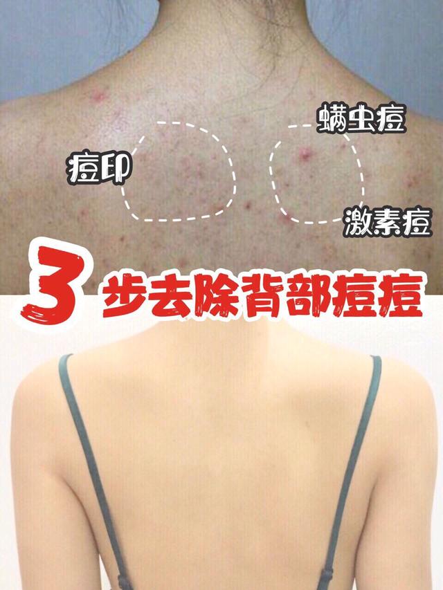 用粉刺针去黑头有效吗，日本EARA去黑头喷雾，有人使用过吗，会伤皮肤吗
