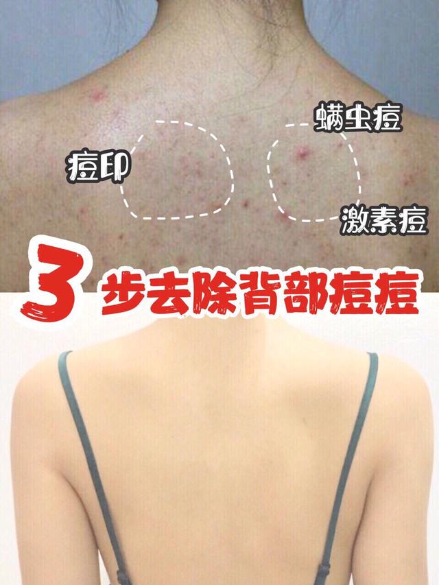 祥生牌癣螨净886:后背长了很多痘痘和黑头，能用粉刺针挤掉吗？如何处理？