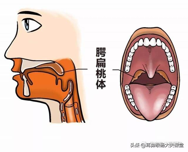 头条问答 扁桃体炎是细菌感染还是病毒感染呢 耳鼻喉杨大夫课堂的回答 0赞