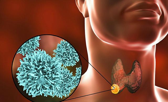 头条问答- 甲状腺结节离癌症有多远？(20个回答)