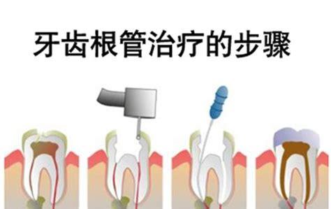 臼齿:臼齿可以拔吗 上牙第一颗臼齿烂透了，只剩半个发黑牙外壳，有必要拔牙吗？