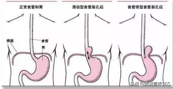 饭后打嗝是什么原因:吃完饭经常打嗝，正常吗？