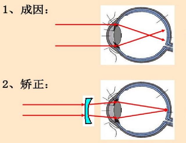 黑眼睛看世界博客:近视600 的世界是怎样的，伸手不见五指吗？