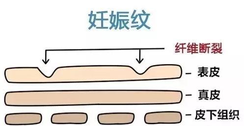 迪维霜可以去生长纹嘛:小男孩十四岁半，膝盖有生长纹还会不会长高？