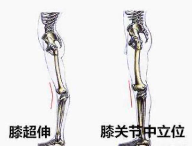 先天膝过伸,导致小腿肌肉很多,这种肌肉腿有办法解决吗？