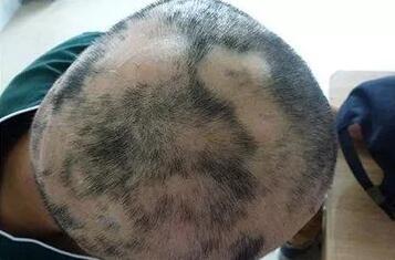 什么原因造成鬼剃头斑秃为什么好了还是反复掉