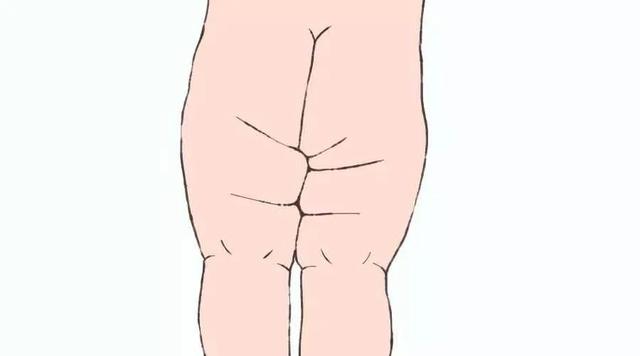 六个月宝宝腿纹不对称怎么回事呀