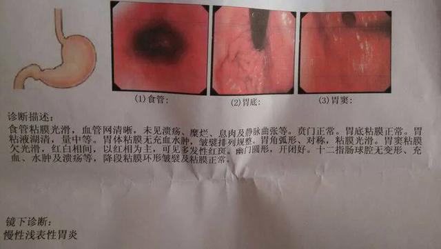 消化系统常见疾病的饮食指导:消化系统疾病与饮食营养 慢性浅表性胃炎，怎么调理，饮食上该怎么注意？