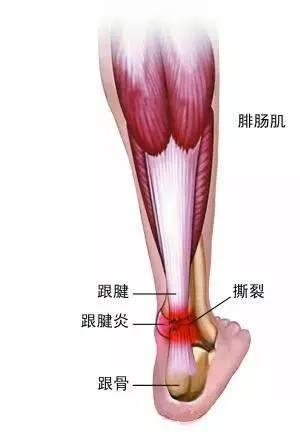 头条问答 - 天天跑五公里,脚后跟痛筋膜炎,在不影响跑步情况下消炎的