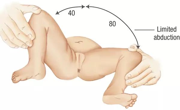 胯关节发育不良:成人型髋关节发育不良的临床表现？
