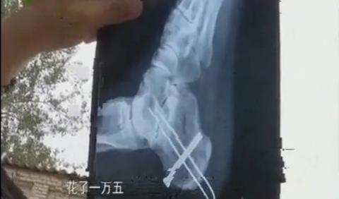 石家庄酒店被砸事件:男子第一天上班5分钟摔成骨折，老板:你故意来讹我的！咋回事？