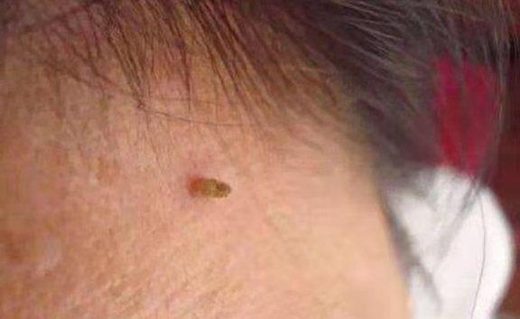 脖子上长出的"肉疙瘩"究竟是什么?