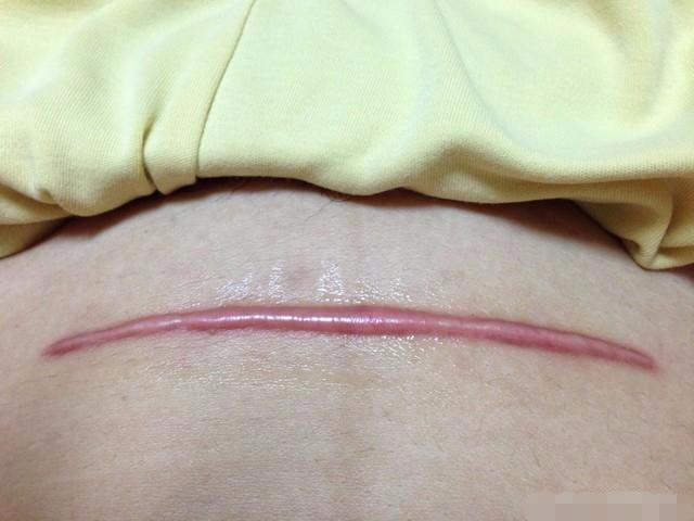 头条问答 - 老婆剖腹产不到一年,现在又怀孕了,请问孩子能要吗?