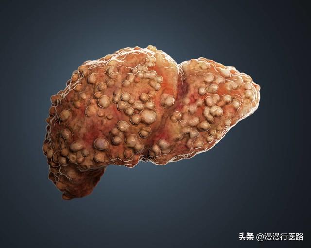 头条问答- 怎么判断肝硬化早中晚期？(香草小医生的回答，0赞）