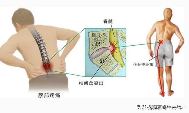 肌肉注射的注意事项:腰间盘突出打针期间要不要练腰背肌？