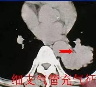 gimpet猫窝:肺结节恶化都有哪些表现？