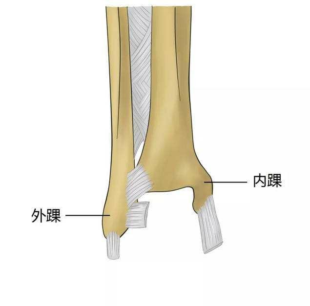 腓骨骨折5周可以拆石膏吗:腓骨远端骨折可以不固定自愈吗？