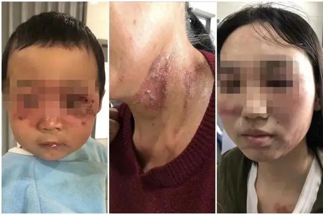 隐翅虫图片:为何最近人民日报发布了隐翅虫相关的提醒？