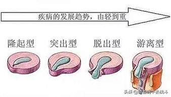 肌肉注射的注意事项:腰间盘突出打针期间要不要练腰背肌？