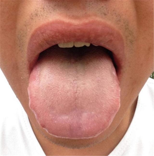 舌头胖大有齿痕，需要怎么调理？插图36