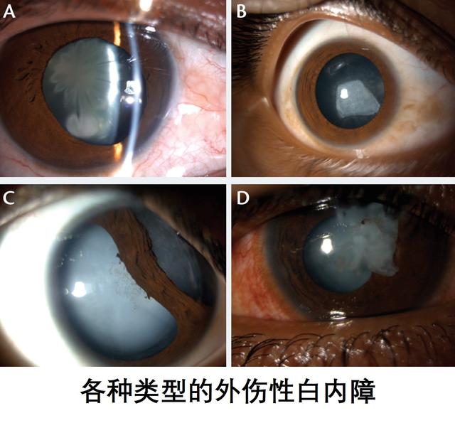 外伤性白内障的原因:儿童外伤性白内障手术要做几次，注意什么？