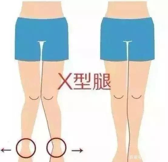 怎么矫正XO型腿，女生的哪些腿型，夏天的时候最好不要露出来