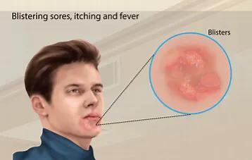 生殖疱疹小腹疼发热吃什么药：生殖性疱疹长在小腹吗