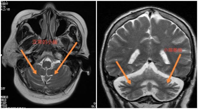 小脑萎缩症的症状有哪些 头条问答