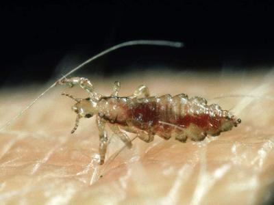 头条问答 - 如何去除虱子卵?(6个回答)