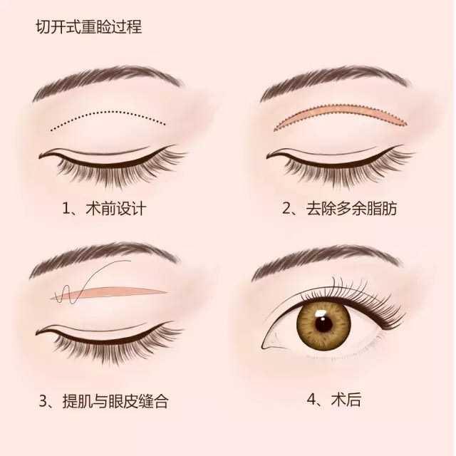 戚薇回应割双眼皮:你会怎么看待割了双眼皮的异性，如果是自己男/女朋友呢
