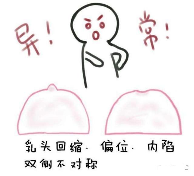 乳腺癌有什么症状表现,乳腺癌有几种类型？哪种最严重？