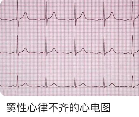 心率变异性怎么解读，“窦性心律不齐”是心脏病吗？