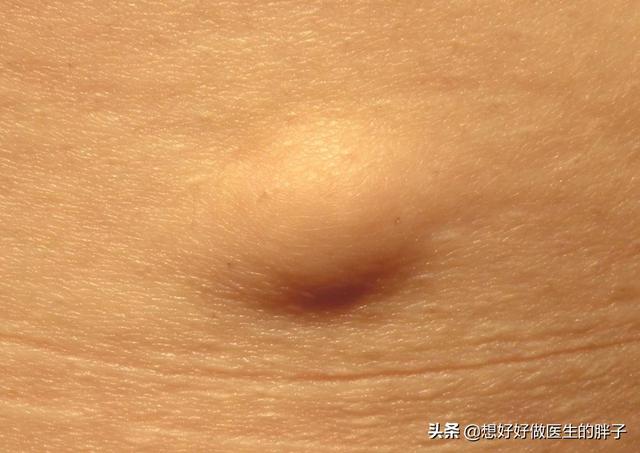 头上长包会得癌吗:脂肪瘤会变成恶性肿瘤吗？