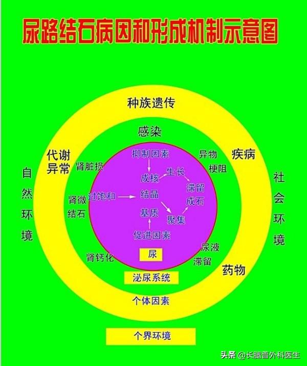 老人尿结石治疗方法:尿结石有什么症状？如何应对？