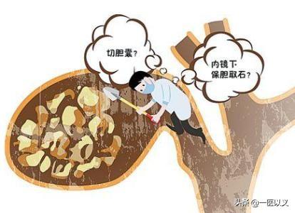 体检发现胆囊结石，不处理的话，以后会怎么样