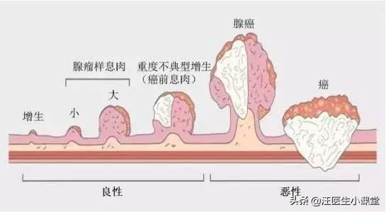 预防肠道疾病教学设计:幼儿园预防肠道疾病教案 肠息肉会发生癌变吗？需要切除吗？怎么才能预防肠息肉呢？