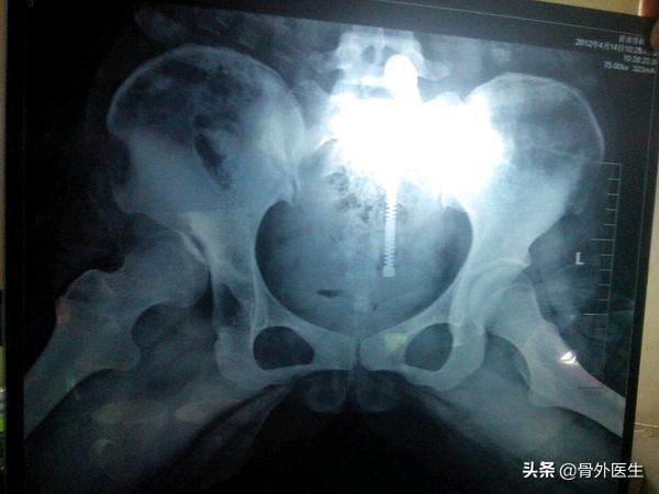 胯关节发育不良:髋关节发育不良的表现有哪些？