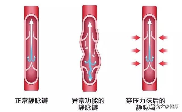 静脉曲张的消炎药有哪些:为什么静脉曲张患者要穿弹力袜？