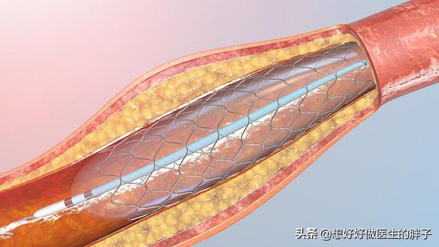 急性心肌梗塞huli:心肌梗死病人在吃药几个月后能爬楼梯吗？