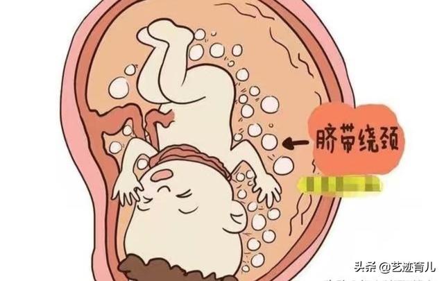 死胎有什么症状:胎停育前期会有哪些症状表现？
