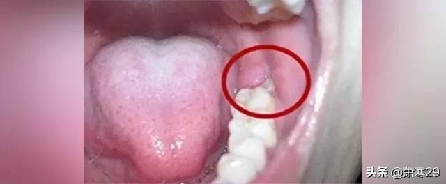 微创拔牙术前准备:拔牙术前准备工作有哪些? 都说拔牙对身体有影响，那么多长出的那颗智齿可以拔掉吗？
