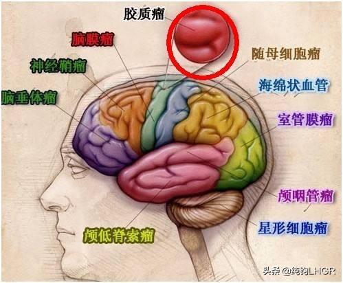 dnet一般从脑血管肿瘤来说,多见于额颞叶,多属于良性病变.
