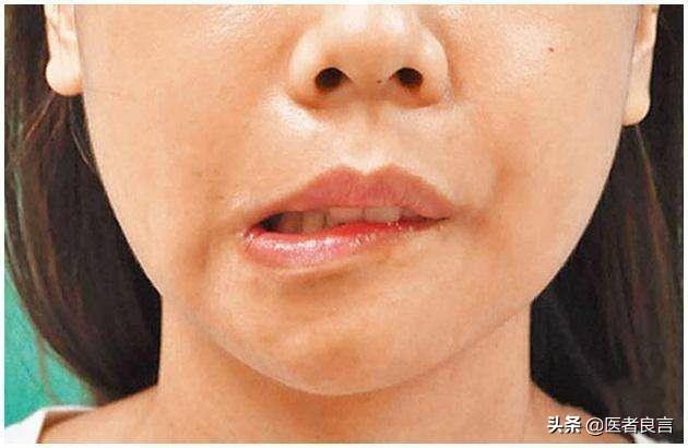 脑梗的症状有哪些:脑梗不是悄无声息的,头部出现哪些表现,表明脑梗要