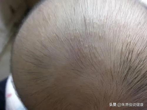 不常见皮肤病症状图片:猪常见皮肤病的症状及图片 头皮里经常长疙瘩，可能有哪些原因？有没有哪些快速消除的办法？