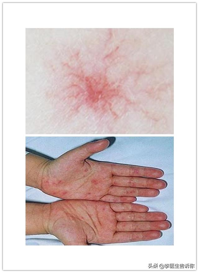 肝硬化有什么症状