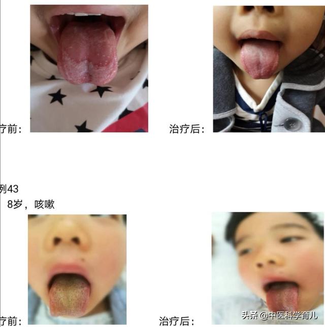 宝宝感冒初期稍微有点流鼻涕，该吃药还是等待自愈？插图7