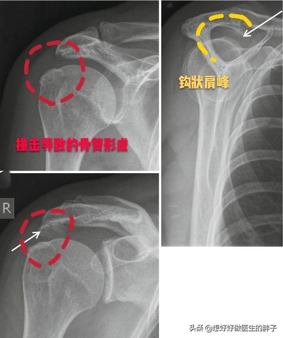 拔罐进风疼痛肩膀疼痛怎么办?肩膀拔罐拔出水泡是怎么回事