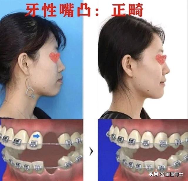 悟空问答 如何矫正凸嘴 33个回答